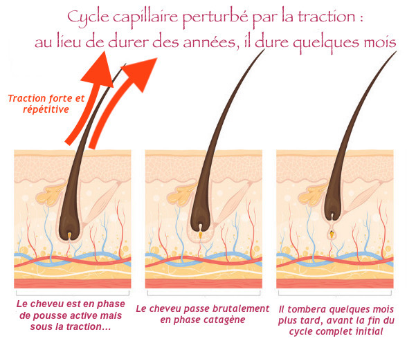 processus alopécie de / par traction